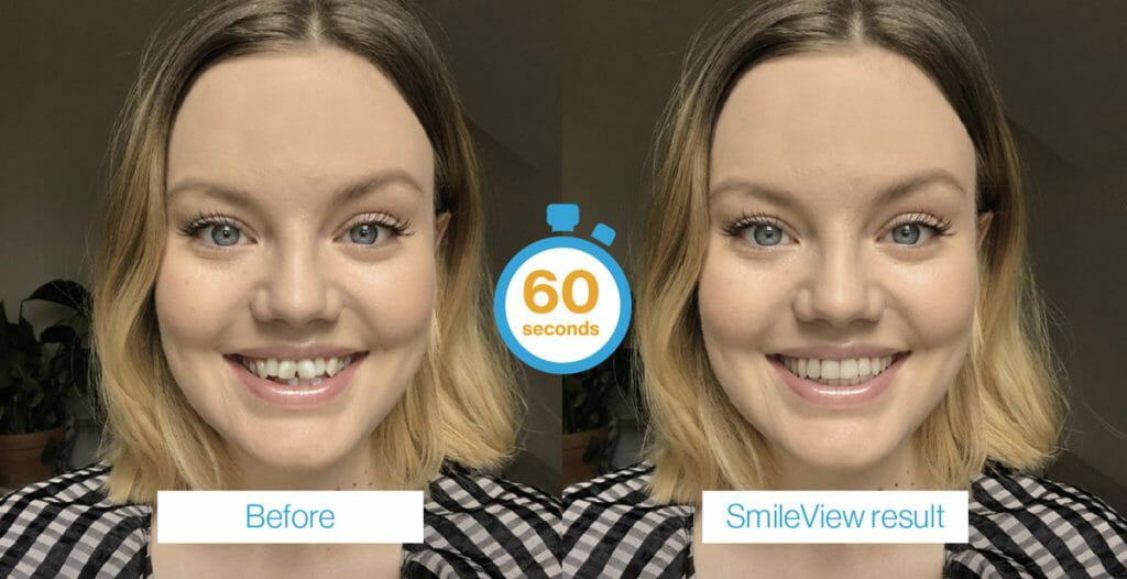 invisalign-smile-view-img1-v1